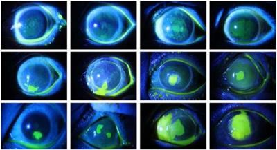 Semi-MsST-GAN: A Semi-Supervised Segmentation Method for Corneal Ulcer Segmentation in Slit-Lamp Images
